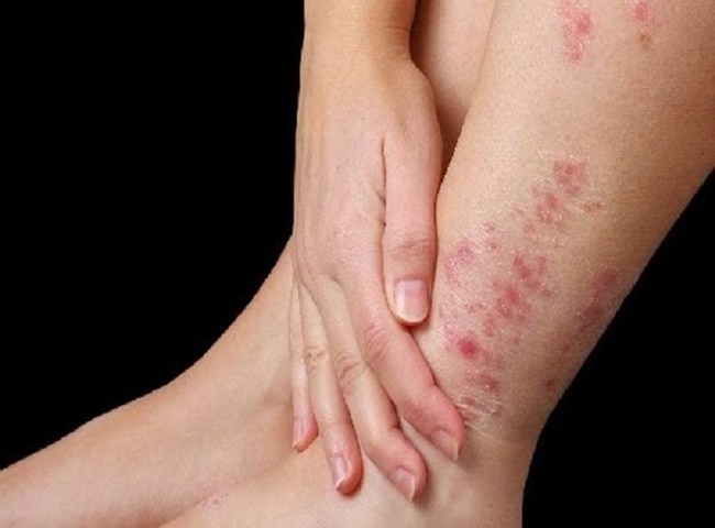 Dị ứng da do mùi hôi quần jean